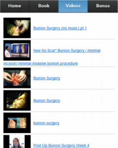 Bunion Surgery